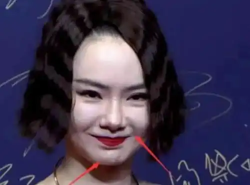 真勇戚薇回应眼睛变形,承认医美没恢复,网友没把观众当傻子